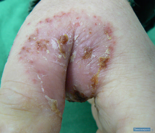 herpes simplex. Herpes simplex recidivans