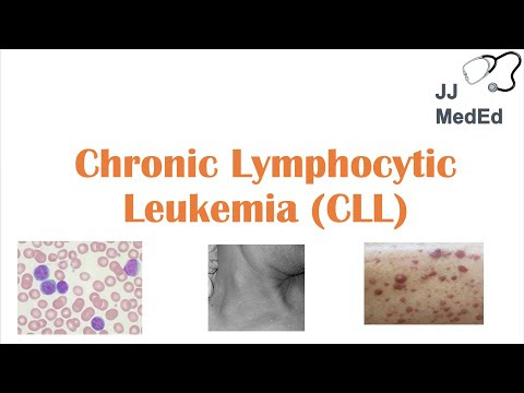 The Best 11 Leukemia Skin Lesions Pictures
