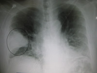 Pneumonia Chest X Ray