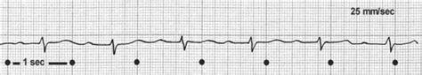 Bei sportlern führen funktionelle und strukturelle adaptationen des herzens sowie physiologische anpassungen des vegetativen nervensystems zu . AV- Block 1. Grades