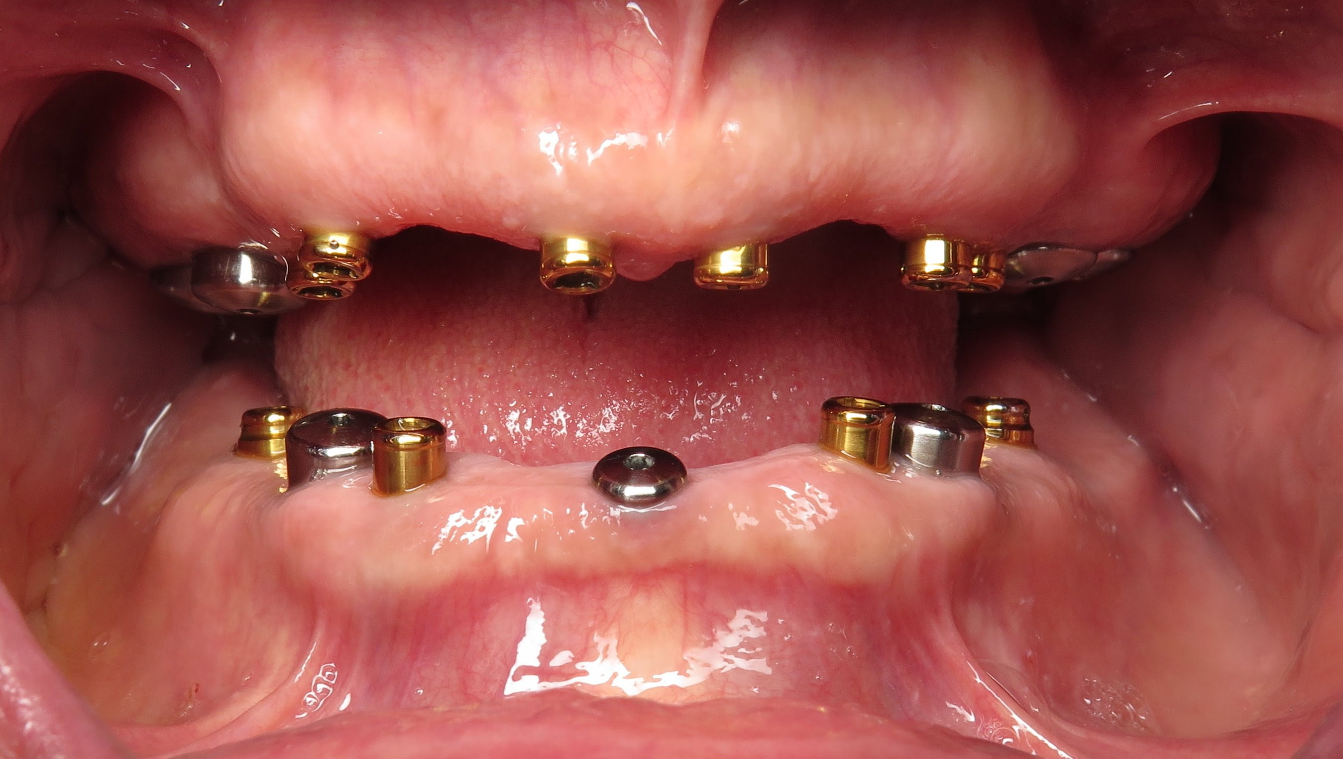 Platinum teeth implants