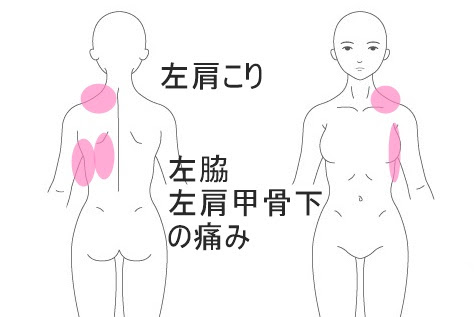 肩こり症例32 代女性 学校を休むほどの左肩 左脇と左肩甲骨下の痛み 背中の痛み症例2 湯沢の整体 女性院長で安心 コスモス自然形体院