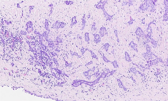 Mesothelioma Pleura Pathology Outlines / Pathology Outlines Mesothelioma Peritoneum Epithelioid - B pathology department, coimbra university hospital, coimbra, portugal.