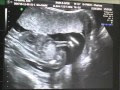 Les 40+ meilleures bebe 17 semaine 102825-Bebe 17 semaine aménorrhée