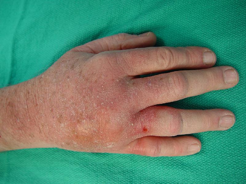 brown recluse spider bite on dog. Probable rown recluse spider