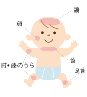 アトピー性皮膚炎とは Seastar 医療従事者向け情報
