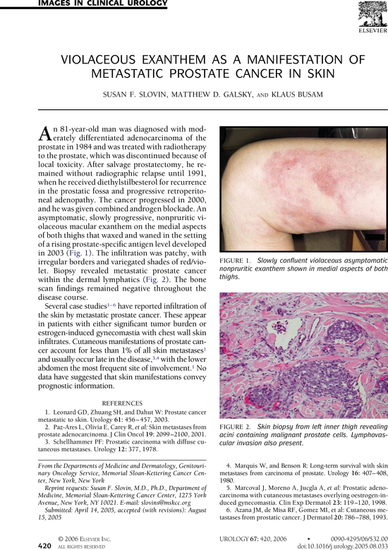 Skin Cancer Symptoms, Types, Images - OnHealth