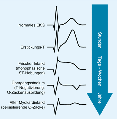 Ekg Herzinfarkt - Hinterwandinfarkt Ekg Bilder - Der herzinfarkt ist bis heute eine der häufigsten todesursachen.