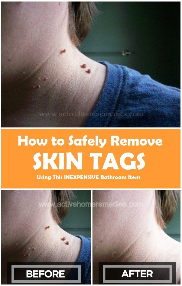 how to remove skin tags using thread