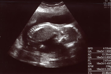 踊る うわばみ妊婦 妊娠18週1日 妖怪的心拍音 ミホちゃん出産