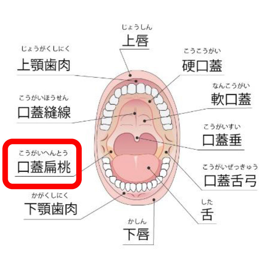 急性扁桃炎の治療と原因 生野区の耳鼻咽喉科 橋本クリニックみみはなのど