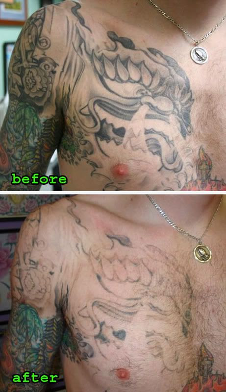 tattoo removal