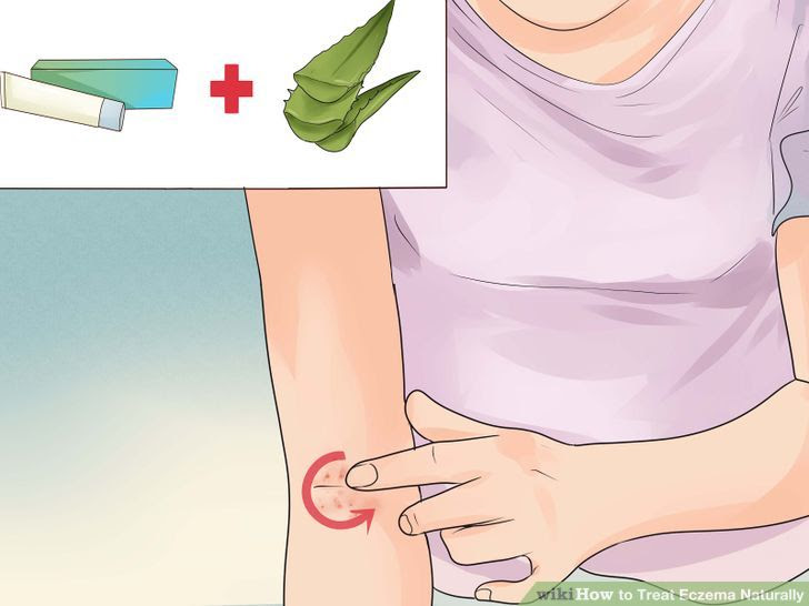 Treat Eczema Naturally Step 9 Version 3.jpg