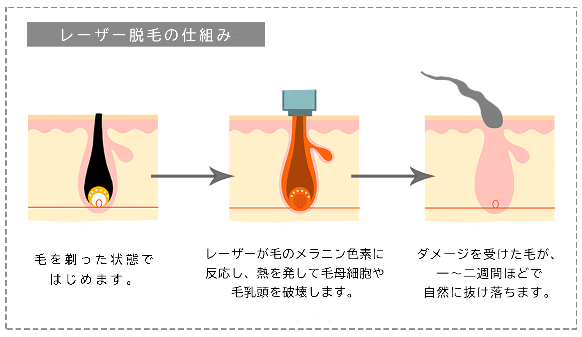 体験談あり ブラジリアンワックスは痛い 痛みを軽減する方法 Angelica アンジェリカ