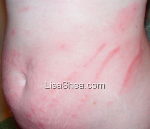 poison ivy rash pics. Photos of Poison Ivy Rashes