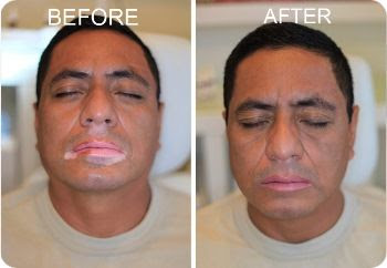 Does Natural Vitiligo Treatment System Work