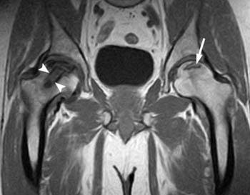 Mri For Prostate Cancer Diagnosis - Targeted Prostate Biopsy using MR/Ultrasound Fusion : But hearing the words can still be scary.