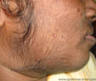 Spderma Center Laser Hair Removal
