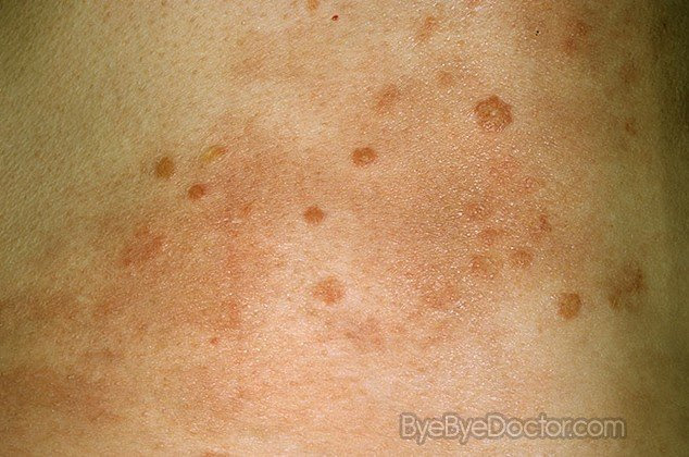 hiv rash