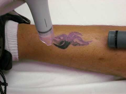 wrecking balm tattoo removal fade complete system