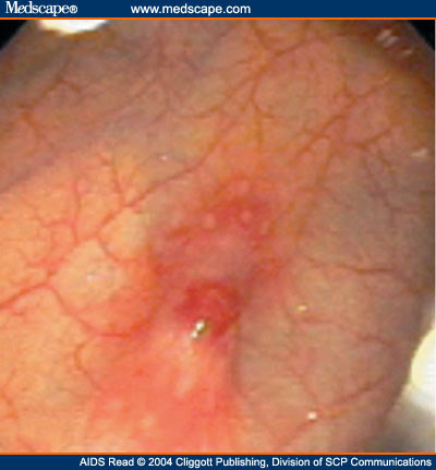 most cancers vessie polype