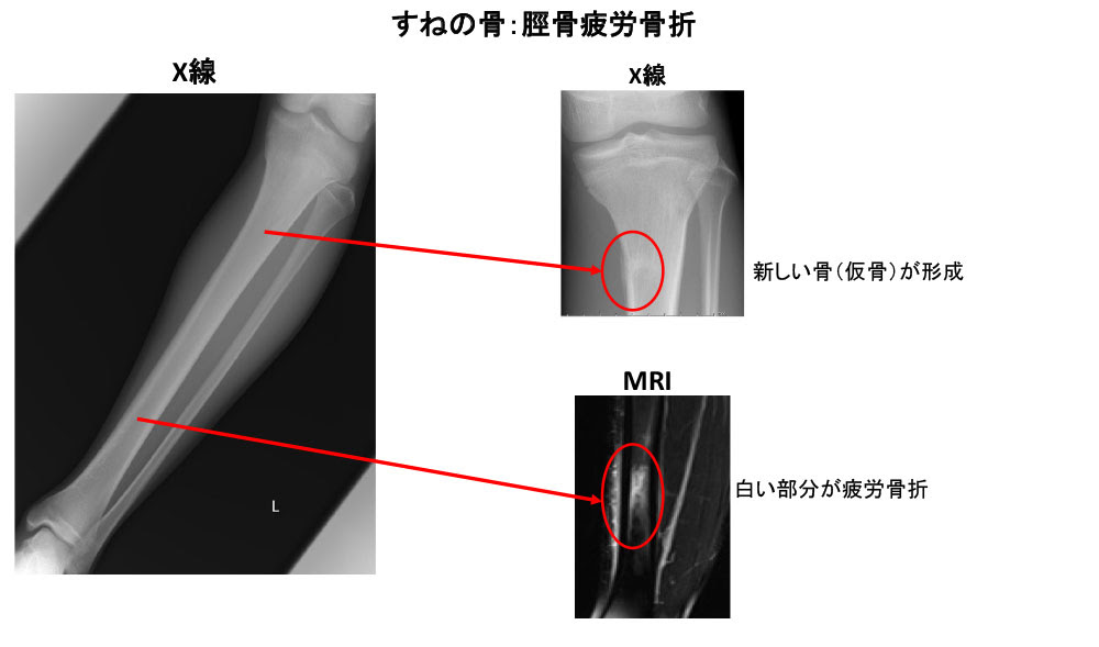 疲労骨折 北海道整形外科記念病院