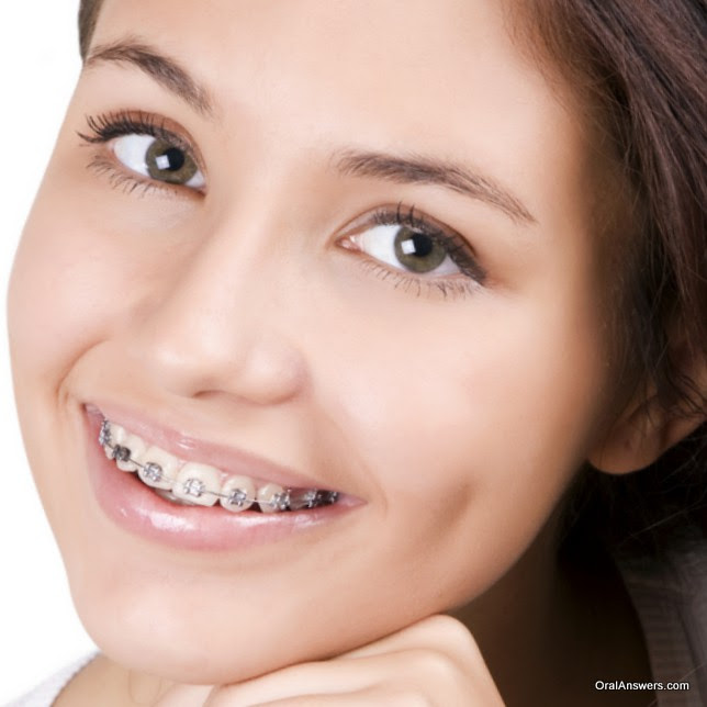 teenage_girl_braces_silver