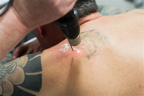 faq  laser tattoo removal hurt andrea catton laser