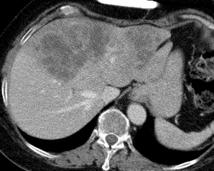 Liver Atlas Case 40 Yttrium 90 Radioembolization