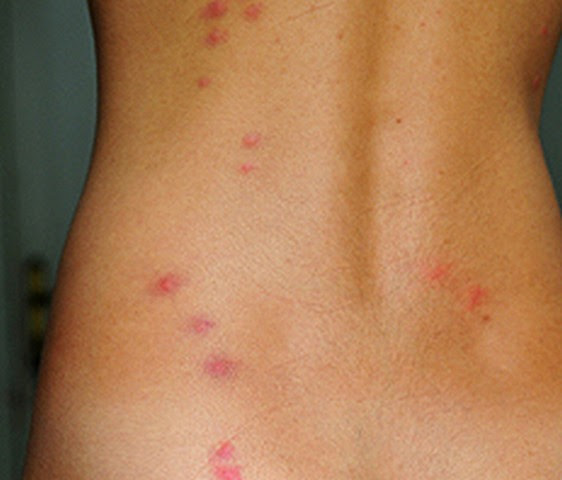 Bed Bug Bite Pictures, Marks, Symptoms, Causes, Treatment