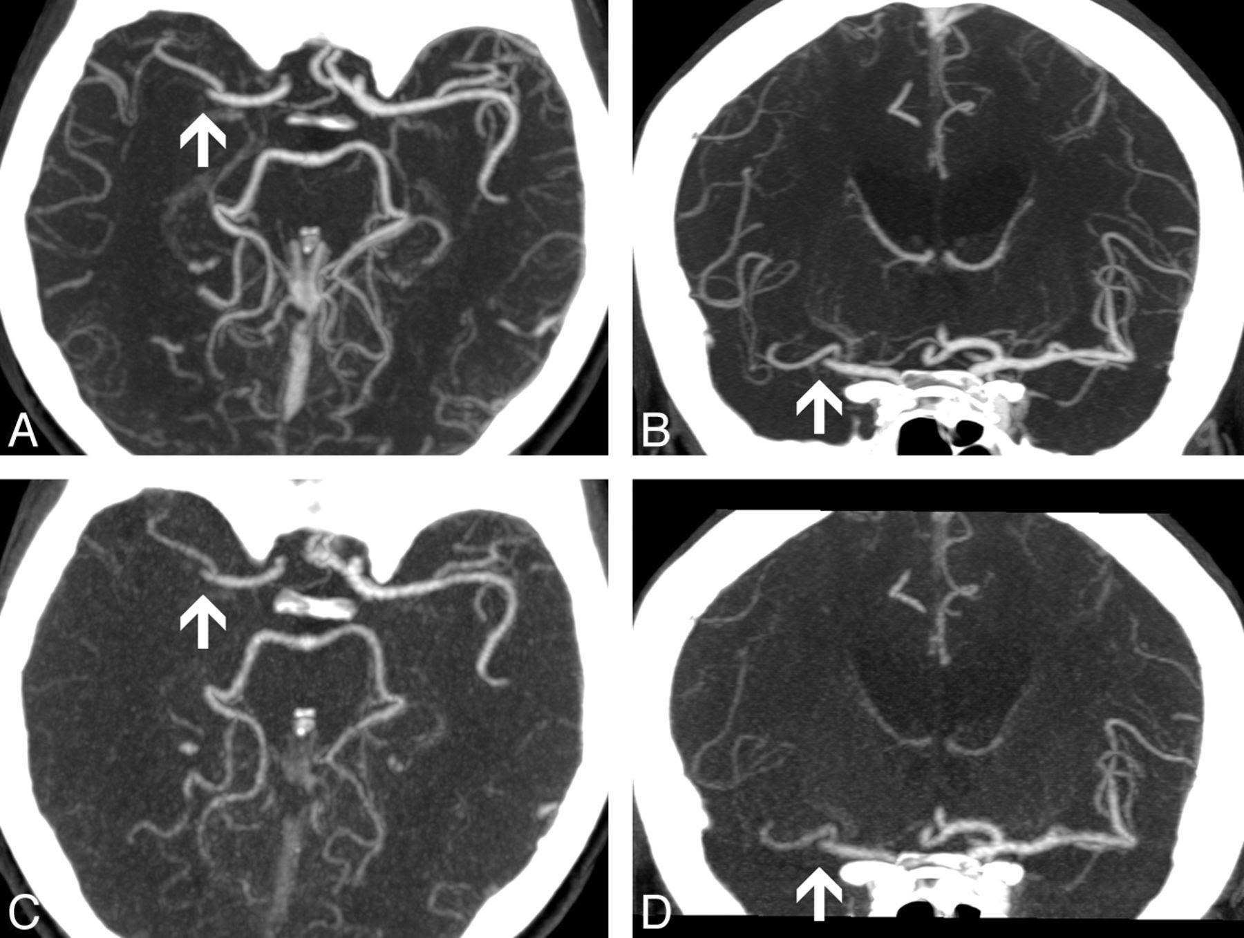 Comparison Of Conventional Cta And Volume Perfusion Cta In Evaluation Of Cerebral Arterial Vasculature In Acute Stroke American Journal Of Neuroradiology