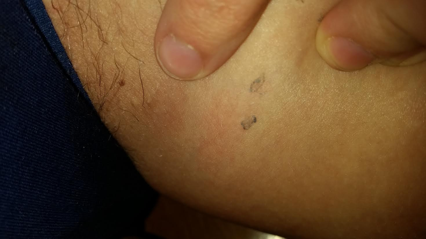 Small Lump Under Skin On Upper Inner Thigh Please Help Freaking Out Askdocs