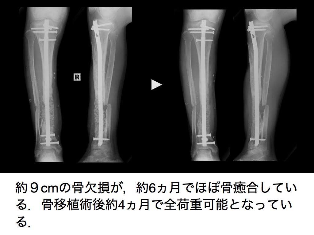 難治骨折診 帝京大学医学部 整形外科学講座