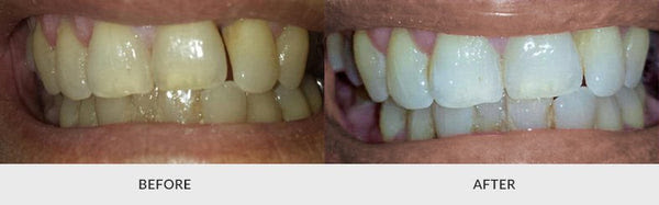 Auraglow deluxe home teeth whitening system