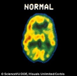 A PET scan of a healthy normal brain shows the activity of neurons