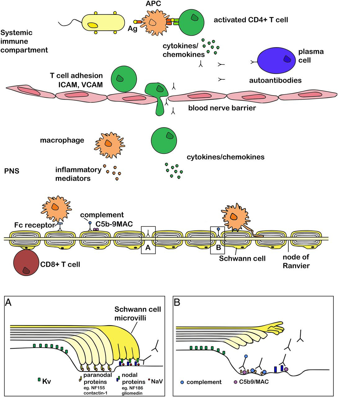 Chronic inflammatory demyelinating polyneuropathy - 