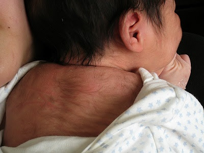 Hirsutism Records Women Health Info Blog