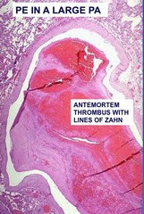 Review of Lung Histology: Vascular Disturbances of the 