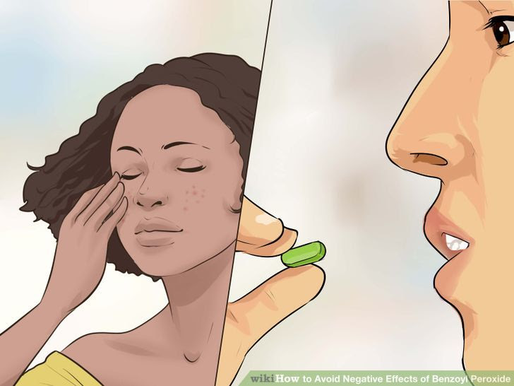 Avoid Negative Effects of Benzoyl Peroxide Step 30.jpg