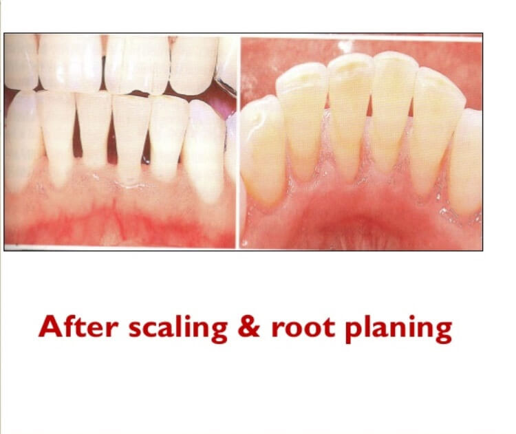 Deep Cleaning Teeth - Cost, Scaling & Planning | Advantage ...