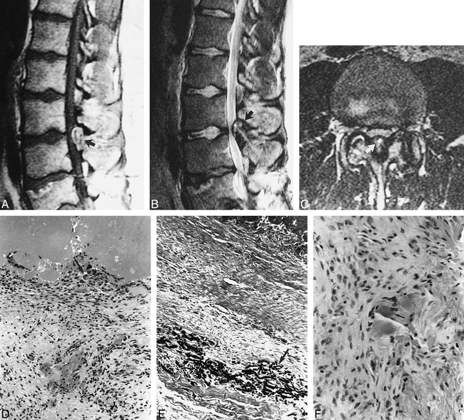 MR Imaging of a Hemorrhagic and Granulomatous Cyst of the ...