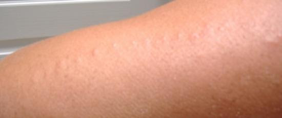 bed bug bites plus scabies on arm - Picture of Bakersfield, California ...