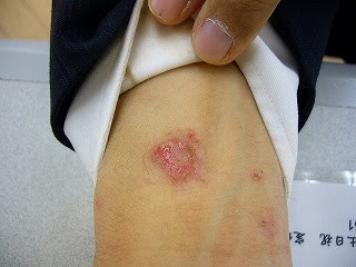 放置すると恐い 貨幣状湿疹 かへいじょうしっしん 美保薬局 福島県いわき市の皮膚病お悩み相談専門の経験豊富な薬局です