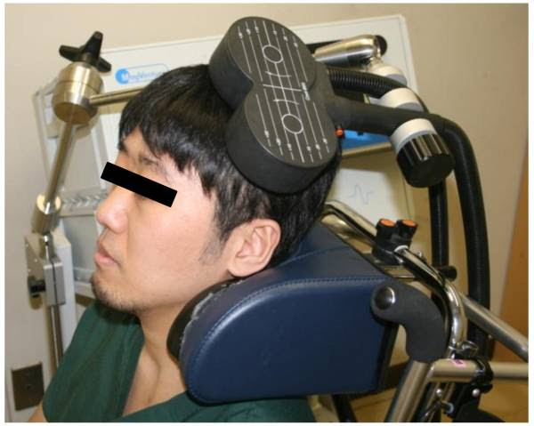 写真：rTMSと無精髭