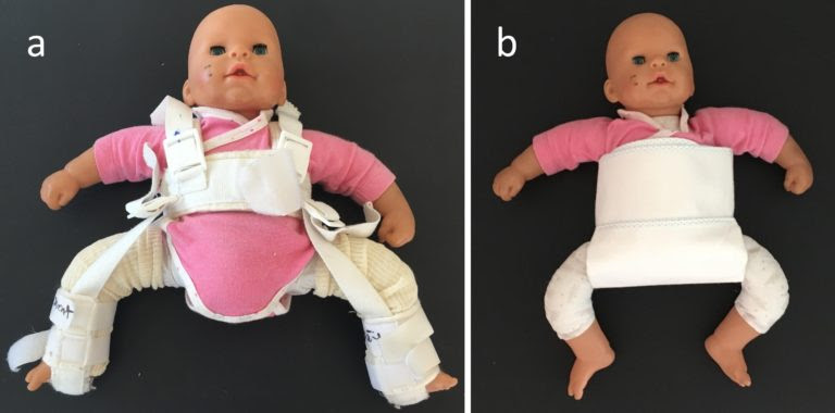 Dysplasie De La Hanche Bebe