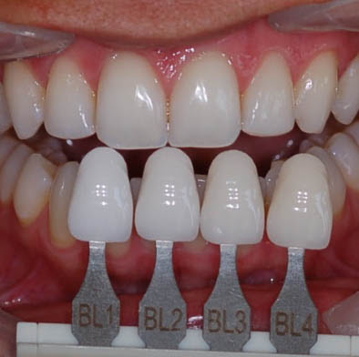 How to choose the best color and shade for porcelain veneers?