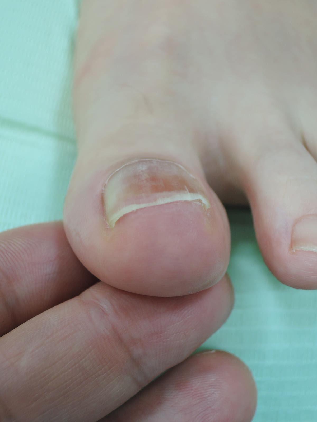 爪を上から抑えると痛い それは 爪下血腫かもしれません 二条駅前 なかみち皮膚科クリニック