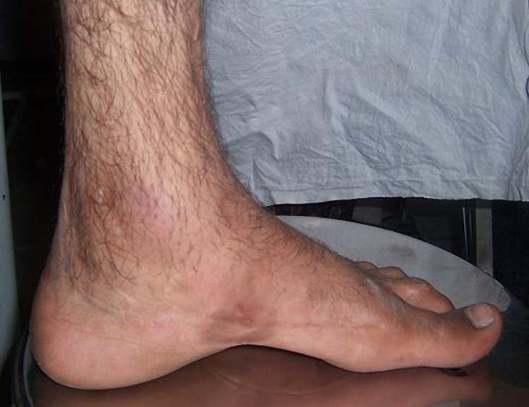 Congenital Talipes Equino Varus Deformity The Foot And Ankle Online Journal