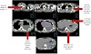 Mesothelioma Cancer Meaning / New Strategies Currently Under Investigation In Malignant Pleural Download Scientific Diagram - The pancreas is a bodily organ that few people think about.