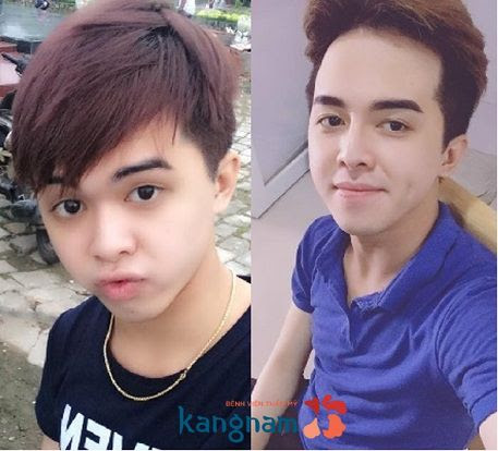 nâng mũi cho nam bao nhiêu tiền-2